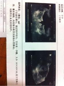 孕9周视频,孕9周胎儿发育与孕妈生活指南