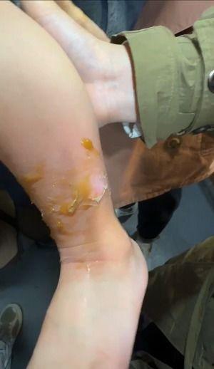 烫伤的视频,揭秘烫伤现场救治全过程